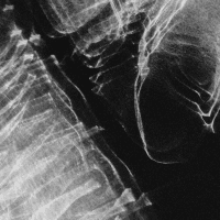 Low-dose lung CT scan for cancer early detection